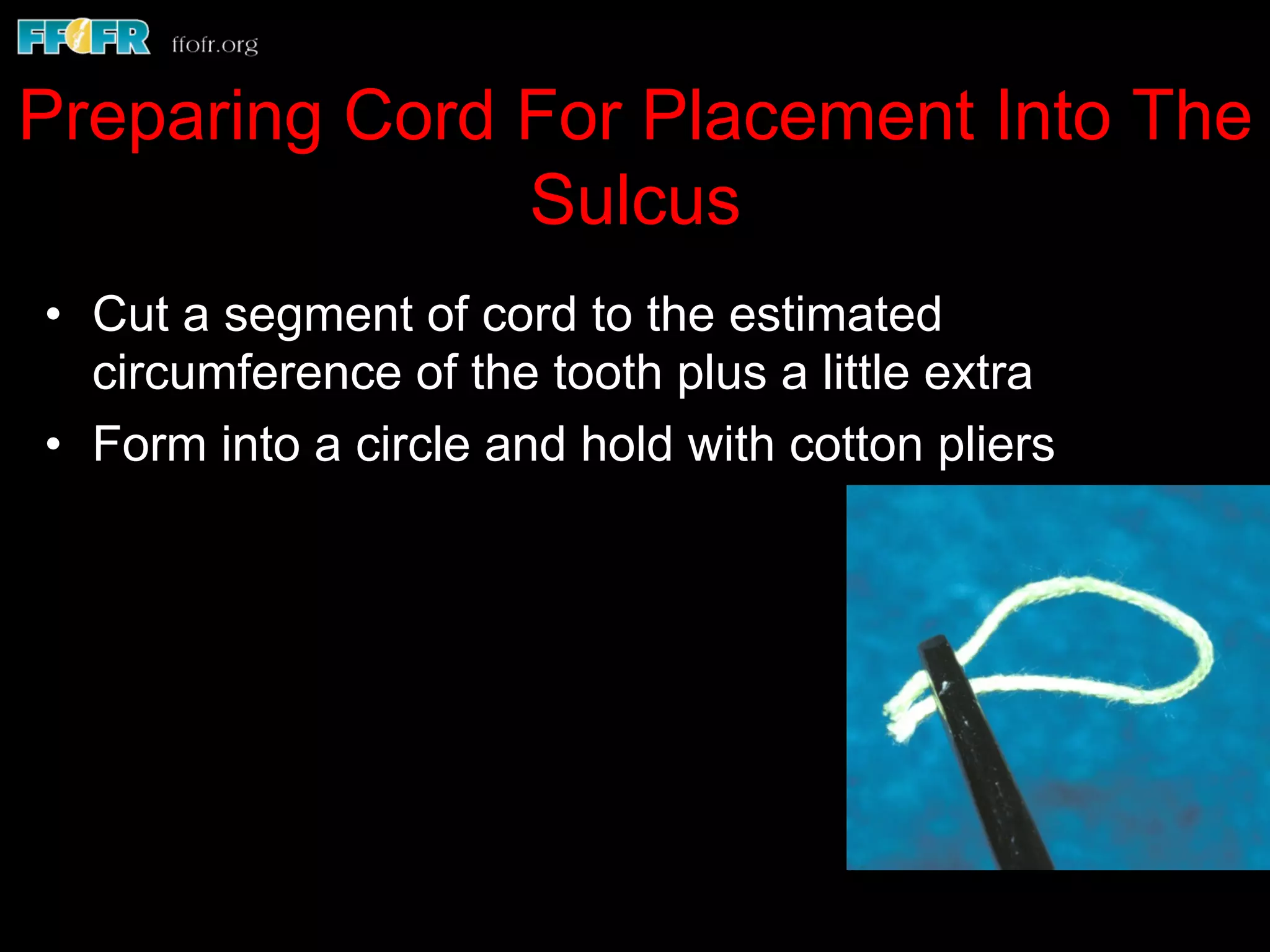 Preparing Cord For Placement Into The
Sulcus
•  Cut a segment of cord to the estimated
circumference of the tooth plus a little extra
•  Form into a circle and hold with cotton pliers
 
