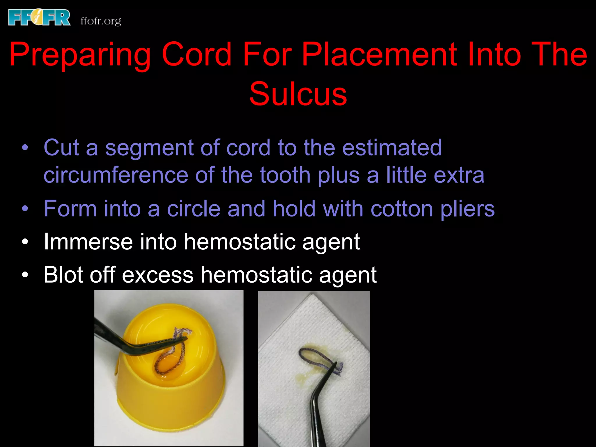 Preparing Cord For Placement Into The
Sulcus
•  Cut a segment of cord to the estimated
circumference of the tooth plus a little extra
•  Form into a circle and hold with cotton pliers
•  Immerse into hemostatic agent
•  Blot off excess hemostatic agent
 