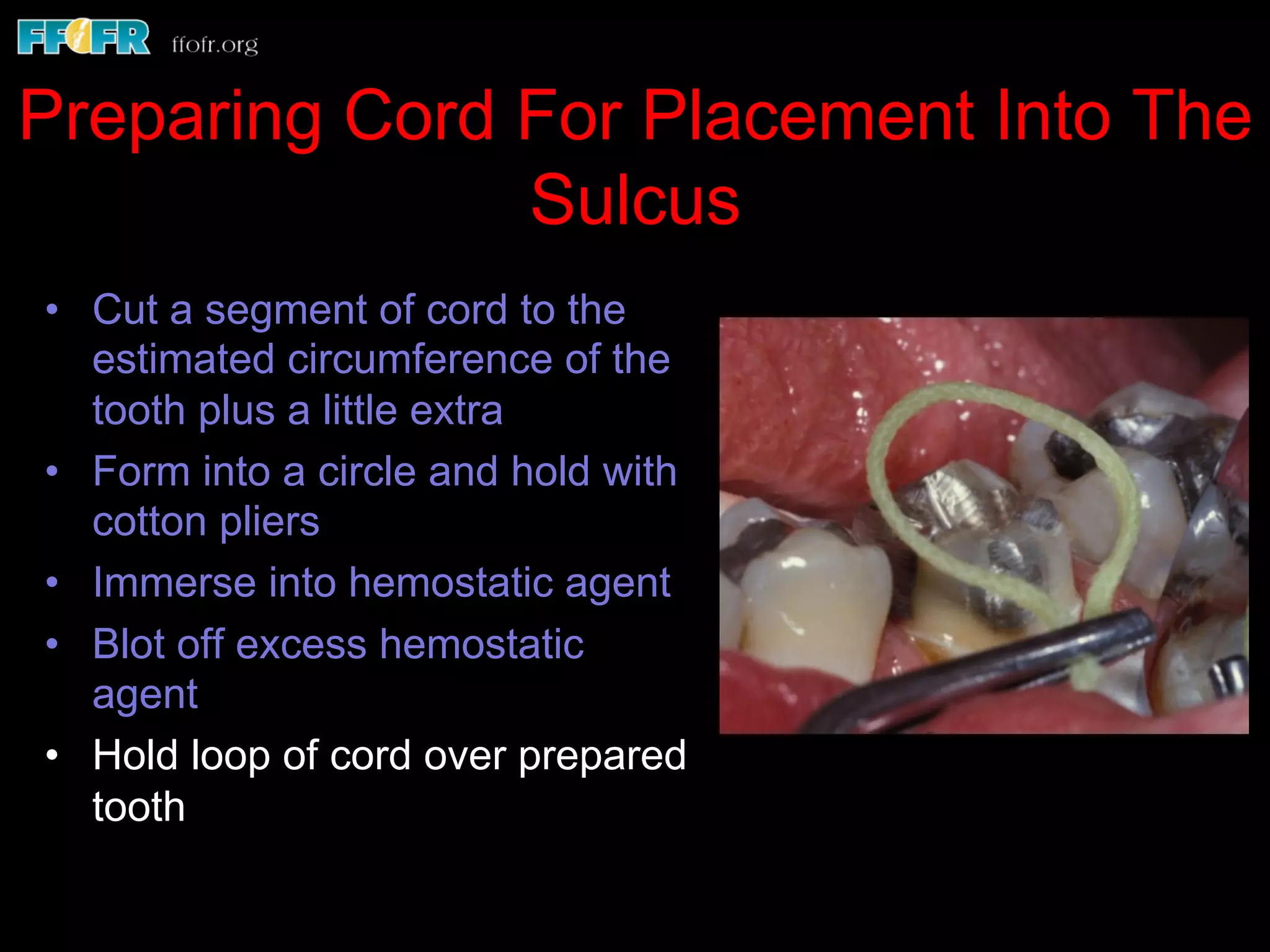 Preparing Cord For Placement Into The
Sulcus
•  Cut a segment of cord to the
estimated circumference of the
tooth plus a little extra
•  Form into a circle and hold with
cotton pliers
•  Immerse into hemostatic agent
•  Blot off excess hemostatic
agent
•  Hold loop of cord over prepared
tooth
 