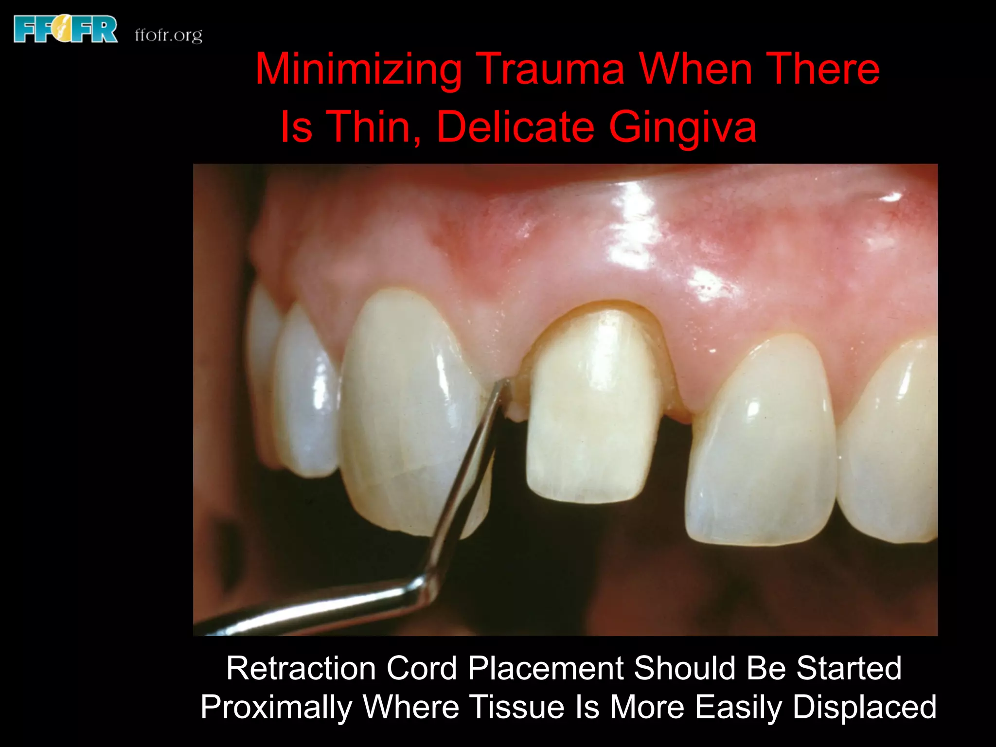 Minimizing Trauma When There
Is Thin, Delicate Gingiva
Retraction Cord Placement Should Be Started
Proximally Where Tissue Is More Easily Displaced
 