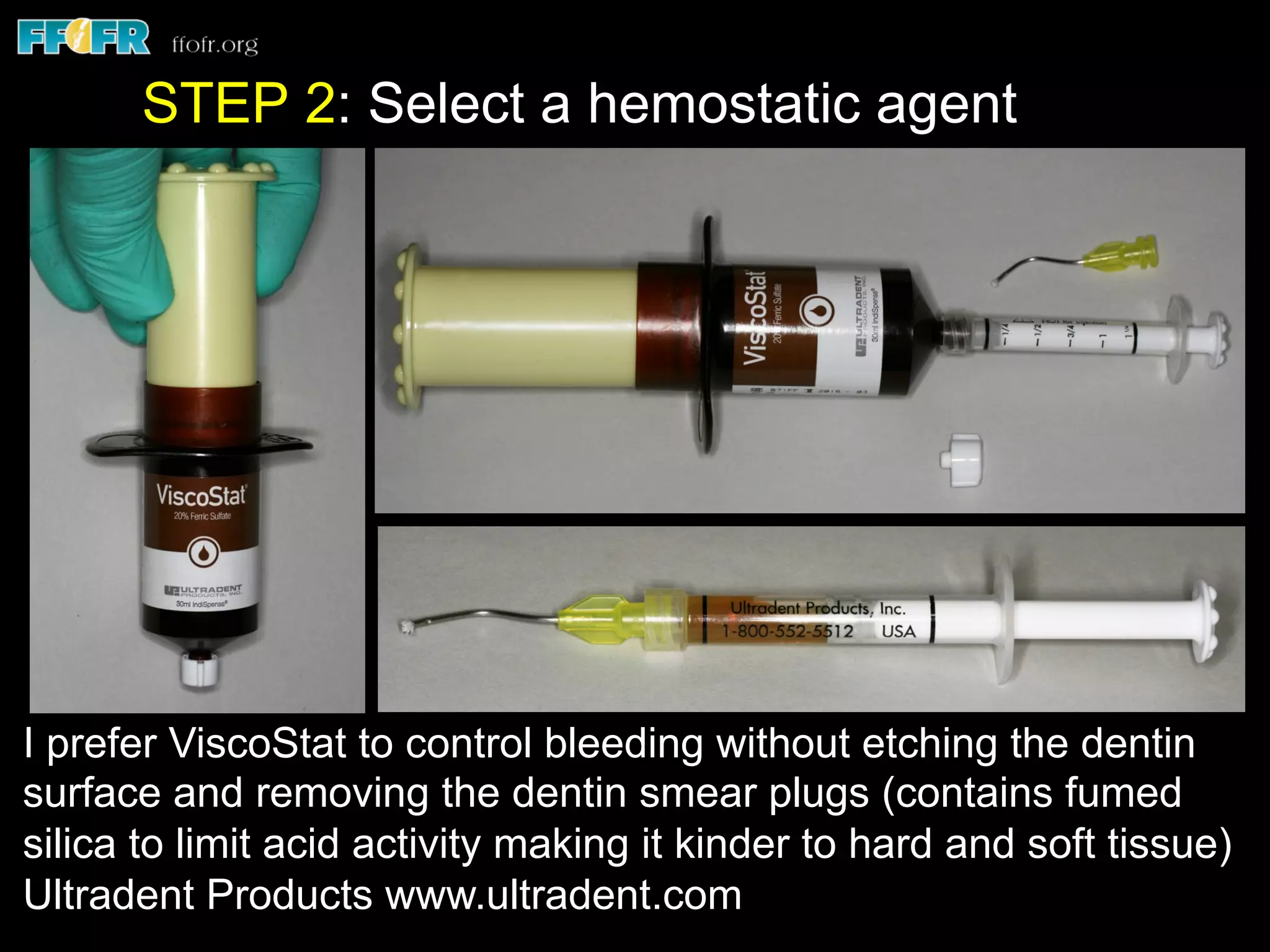 I prefer ViscoStat to control bleeding without etching the dentin
surface and removing the dentin smear plugs (contains fumed
silica to limit acid activity making it kinder to hard and soft tissue)
Ultradent Products www.ultradent.com
STEP 2: Select a hemostatic agent
 