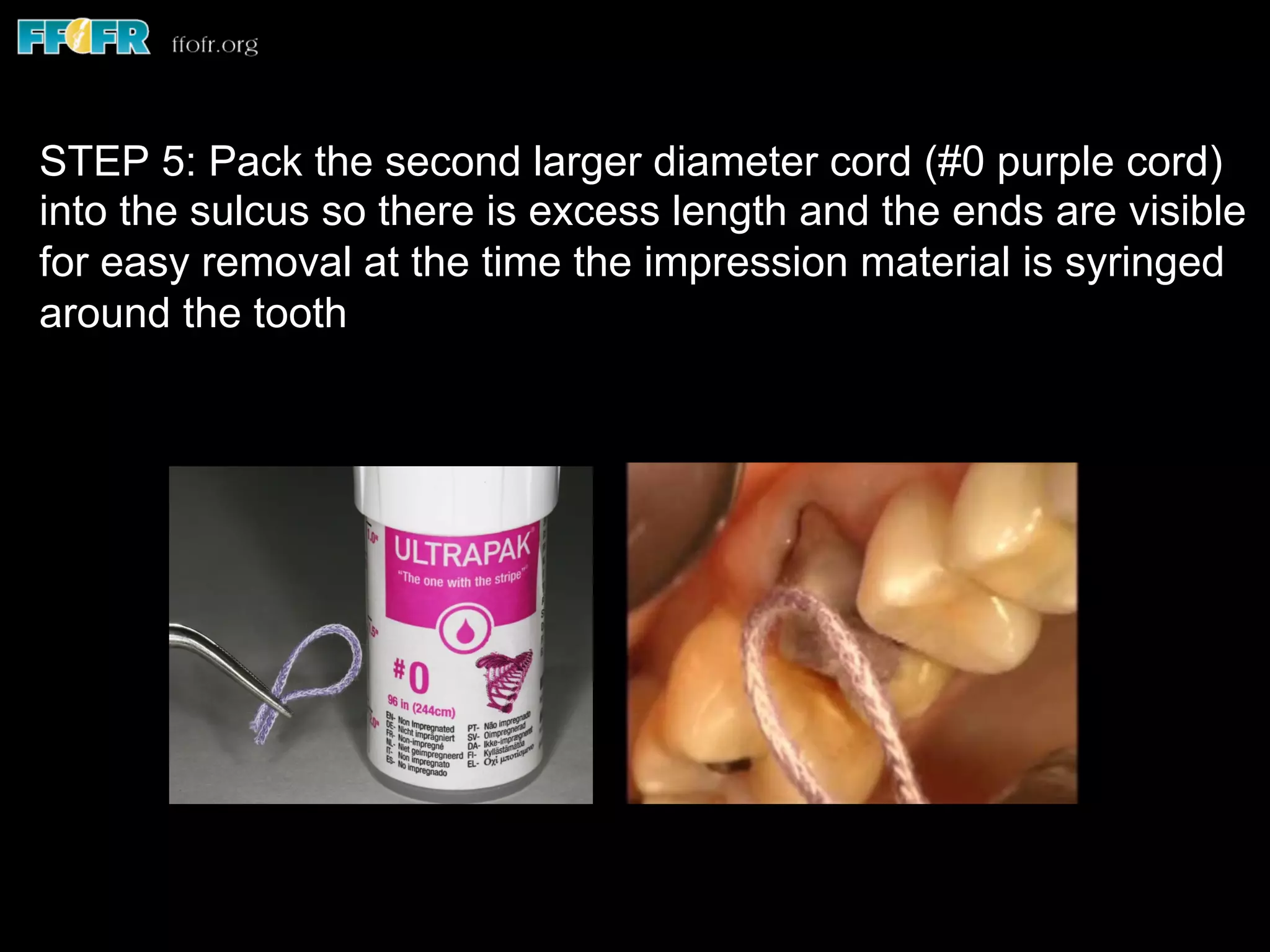 STEP 5: Pack the second larger diameter cord (#0 purple cord)
into the sulcus so there is excess length and the ends are visible
for easy removal at the time the impression material is syringed
around the tooth
 