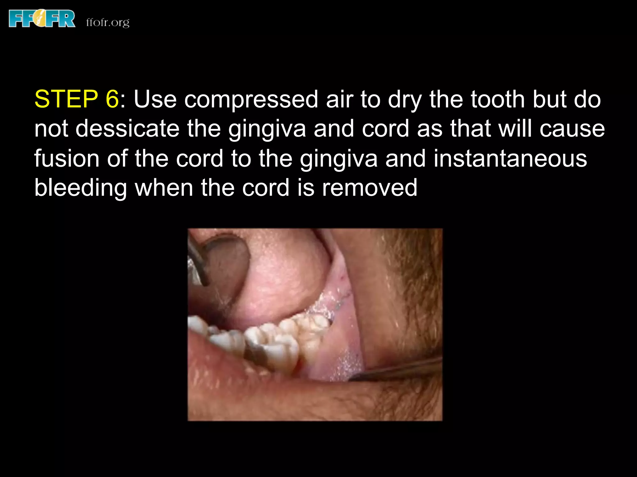 STEP 6: Use compressed air to dry the tooth but do
not dessicate the gingiva and cord as that will cause
fusion of the cord to the gingiva and instantaneous
bleeding when the cord is removed
 