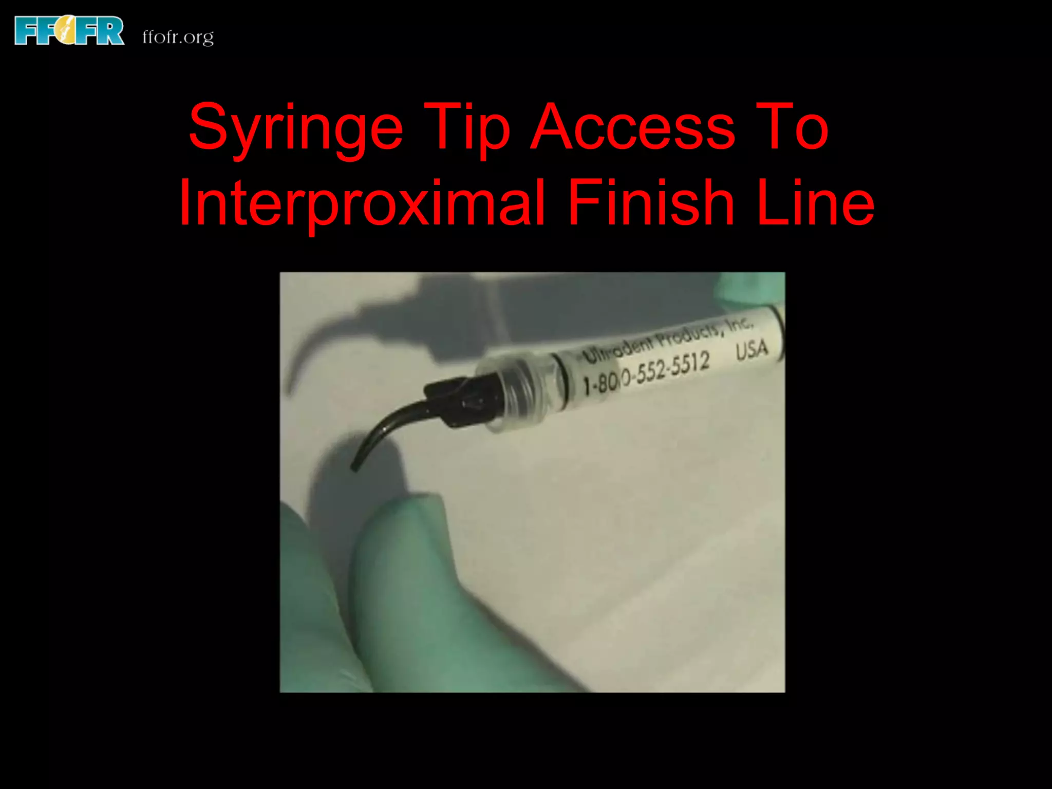 Syringe Tip Access To
Interproximal Finish Line
 