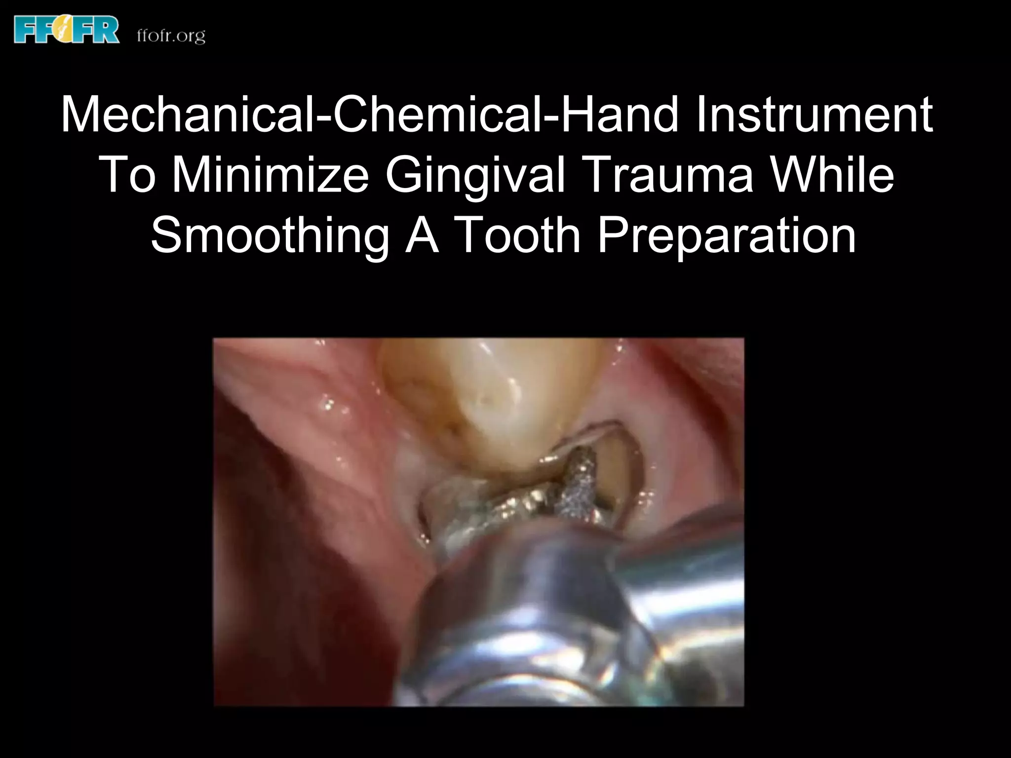 Mechanical-Chemical-Hand Instrument
To Minimize Gingival Trauma While
Smoothing A Tooth Preparation
 