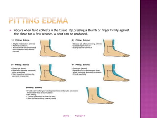  occurs when fluid collects in the tissue. By pressing a thumb or finger firmly against
the tissue for a few seconds, a dent can be produced.
4/22/2014drjma
 
