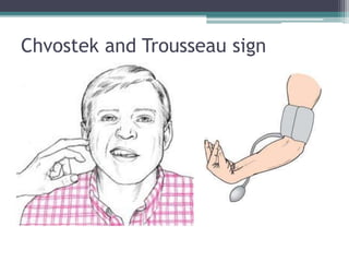 Chvostek and Trousseau sign
 
