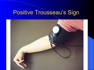 Positive Trousseau’s SignPositive Trousseau’s Sign
 