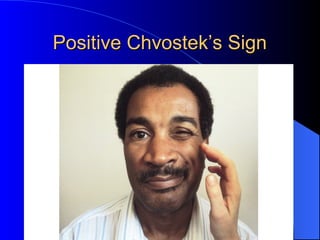 Positive Chvostek’s SignPositive Chvostek’s Sign
 