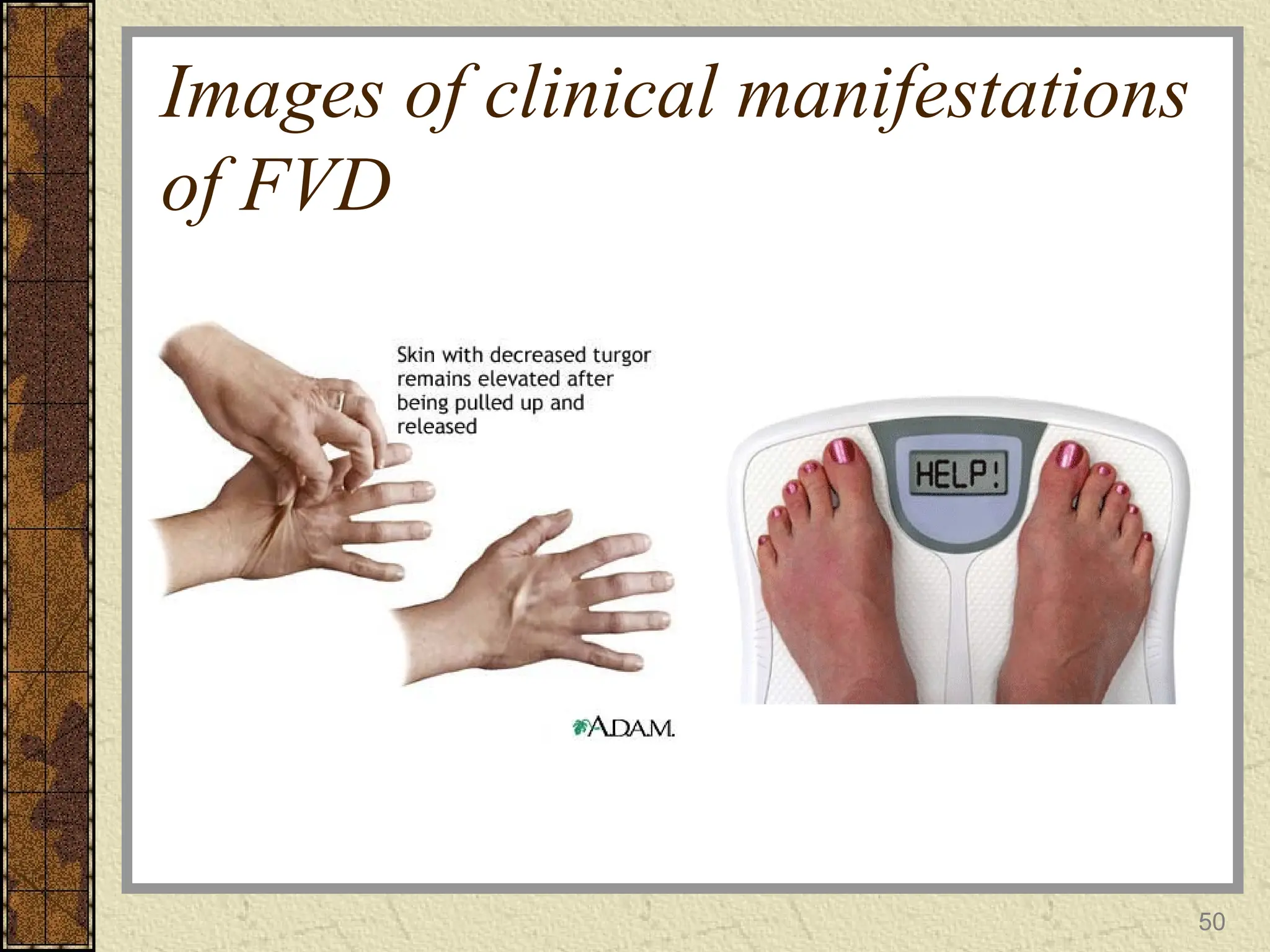 Images of clinical manifestations
of FVD
50
 