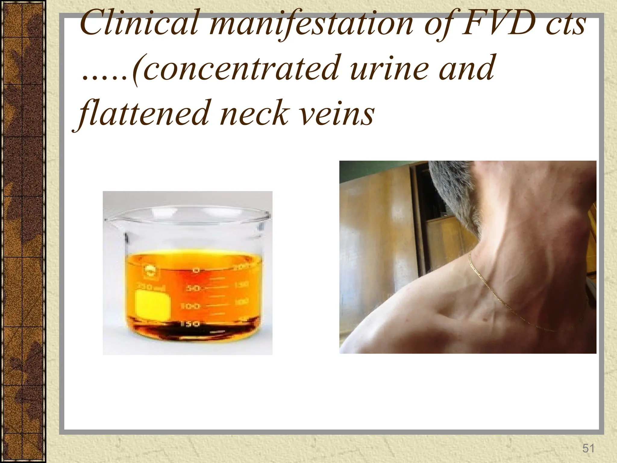 Clinical manifestation of FVD cts
…..(concentrated urine and
flattened neck veins
51
 