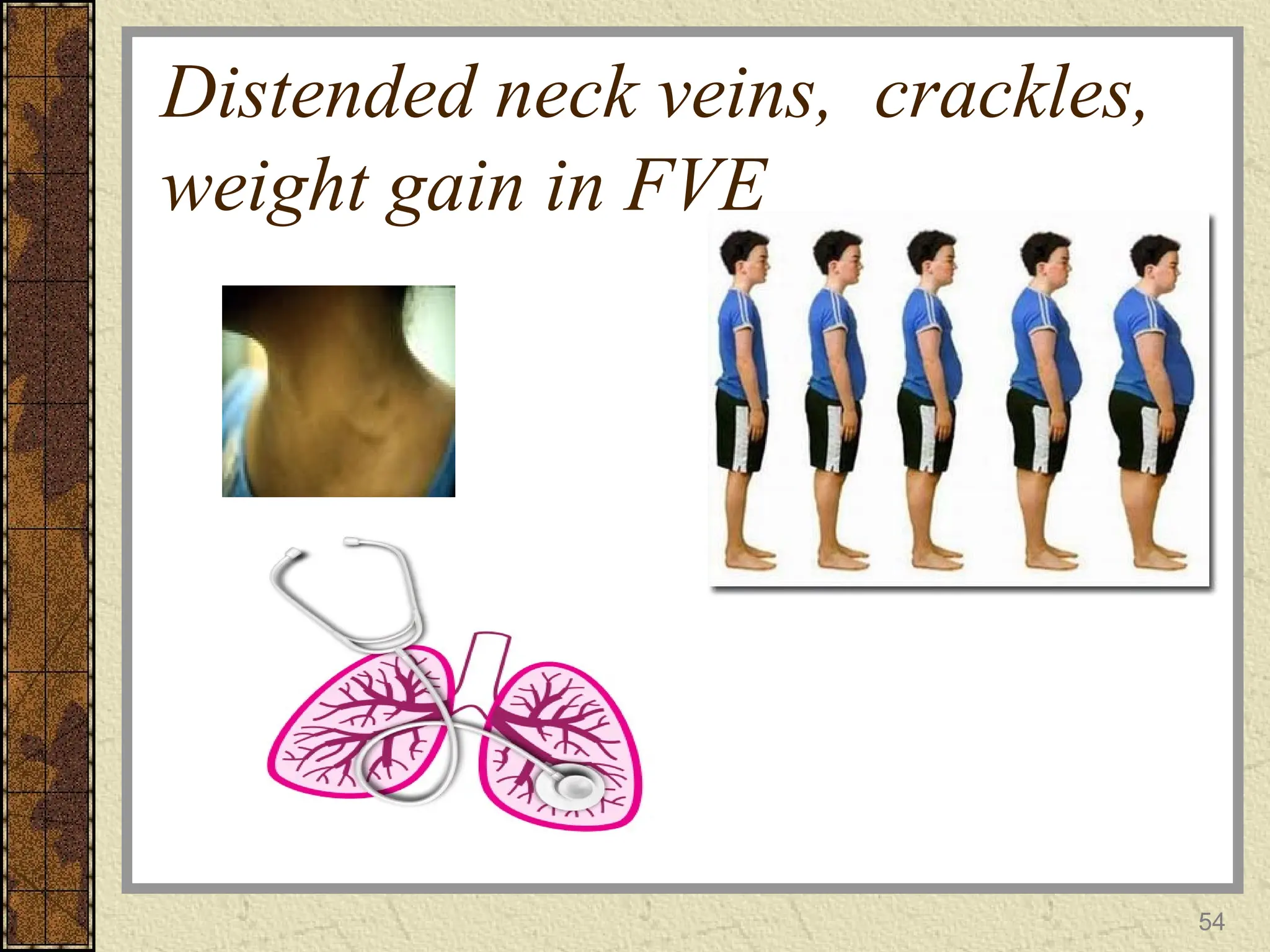 Distended neck veins, crackles,
weight gain in FVE
54
 