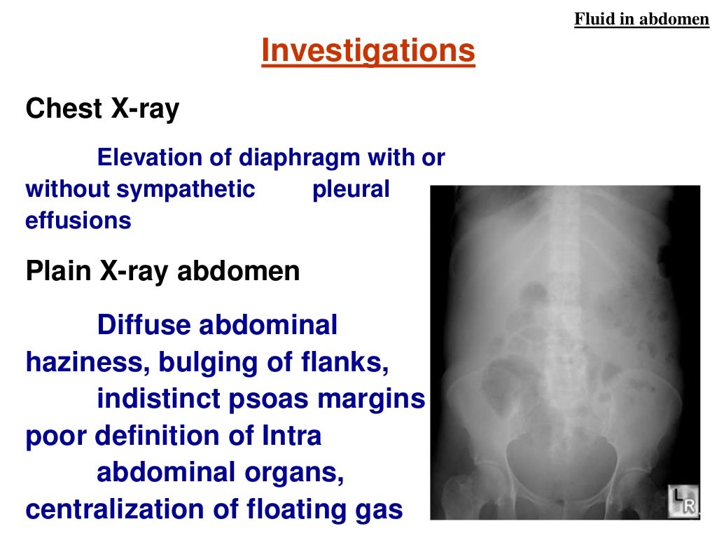 Fluid in abdomen