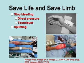 Save Life and Save Limb
Stop bleeding
Direct pressure
Tourniquet
Splinting
Rudge WBJ, Rudge BCJ, Rudge CJ. Ann R Coll Surg Engl.
2010 January;92(1):77-78
 