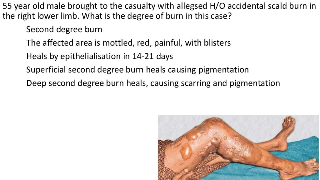 Fluid Management In Burns And Shock