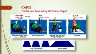 CAPD
Continuous Ambulatory Peritoneal Dialysis
15
 