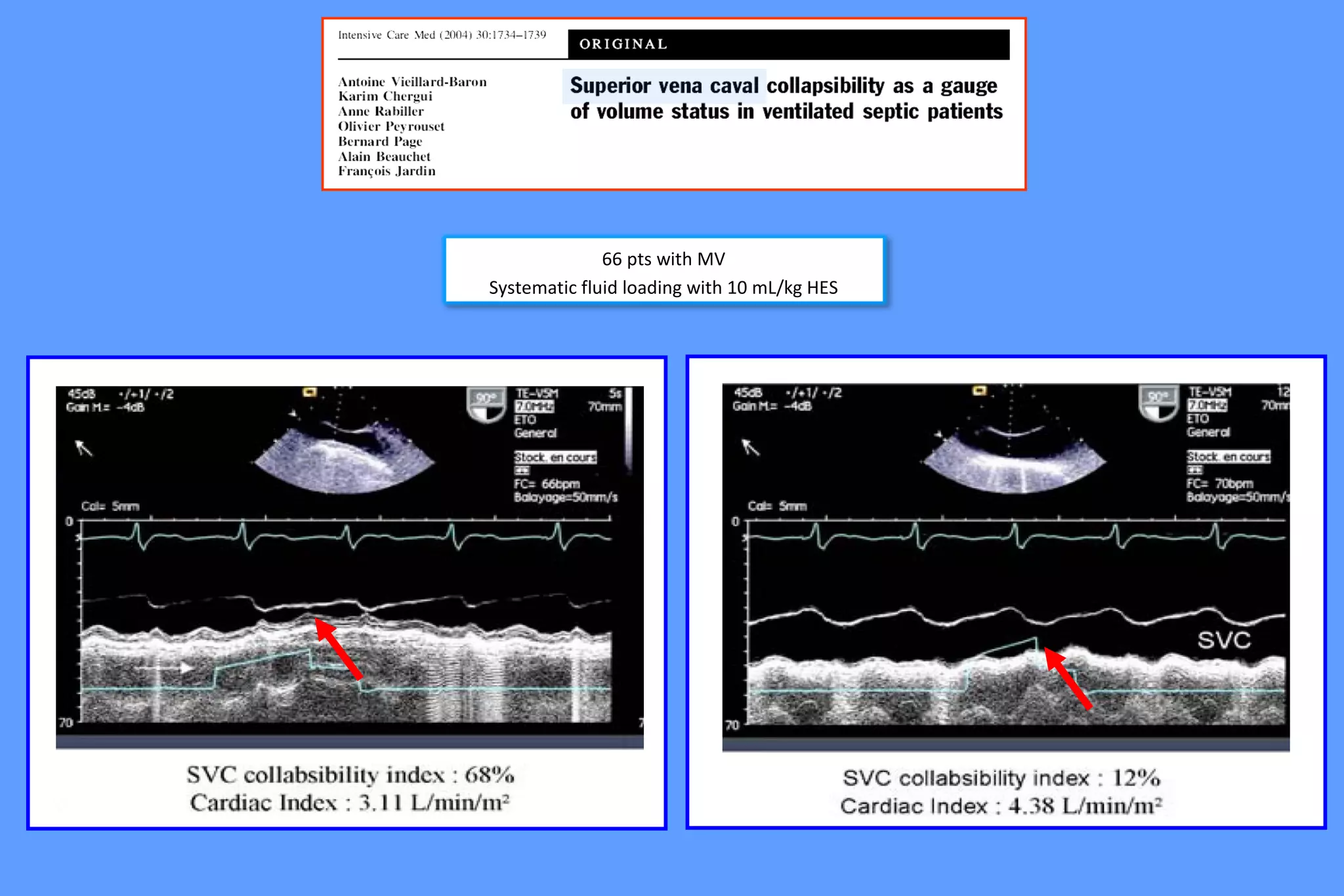 66 pts with MV
Systematic fluid loading with 10 mL/kg HES
 