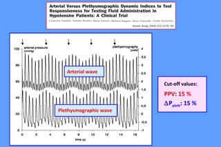 Cut-off values:
PPV: 15 %
∆Ppleth: 15 %
Arterial wave
Plethysmographic wave
 