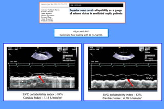 66 pts with MV
Systematic fluid loading with 10 mL/kg HES
 