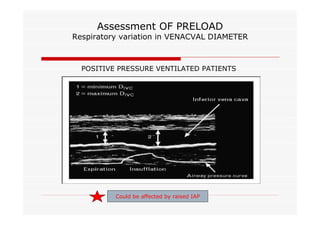 Assessment OF PRELOAD

Respiratory variation in VENACVAL DIAMETER

POSITIVE PRESSURE VENTILATED PATIENTS

Could be affected by raised IAP

 