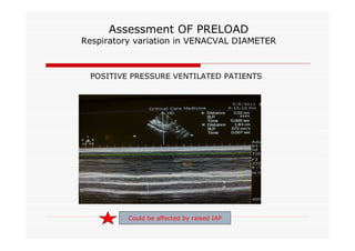 Assessment OF PRELOAD

Respiratory variation in VENACVAL DIAMETER

POSITIVE PRESSURE VENTILATED PATIENTS

Could be affected by raised IAP

 