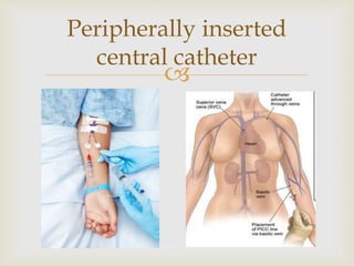 Peripherally inserted 
central catheter 
 
 