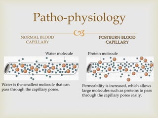 Patho-physiology 
 
NORMAL BLOOD 
CAPILLARY 
POSTBURN BLOOD 
CAPILLARY 
Water molecule 
Water is the smallest molecule that can 
pass through the capillary pores. 
Protein molecule 
Permeability is increased, which allows 
large molecules such as proteins to pass 
through the capillary pores easily. 
 