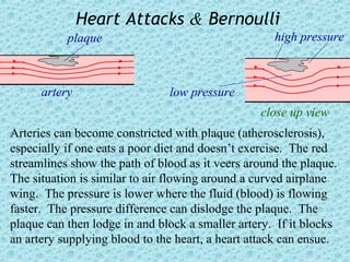 Heart Attacks & Bernoulli
           plaque                                   high pressure



      artery                   low pressure
                                                 close up view
Arteries can become constricted with plaque (atherosclerosis),
especially if one eats a poor diet and doesn’t exercise. The red
streamlines show the path of blood as it veers around the plaque.
The situation is similar to air flowing around a curved airplane
wing. The pressure is lower where the fluid (blood) is flowing
faster. The pressure difference can dislodge the plaque. The
plaque can then lodge in and block a smaller artery. If it blocks
an artery supplying blood to the heart, a heart attack can ensue.
 