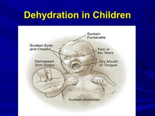 Degrees Of Dehydration in adults
Mild=2%of total body water ~ 1-1.4lit
ThirstThirst
Marked=5% of total body water ~ 3-3.5l...