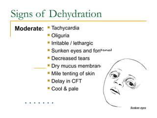 Signs of Dehydration
 Tachycardia
 Oliguria
 Irritable / lethargic
 Sunken eyes and fontanel
 Decreased tears
 Dry mucus membranes
 Mile tenting of skin
 Delay in CFT
 Cool & pale
Moderate:
 