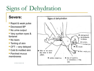 Signs of Dehydration
 Rapid & weak pulse
 Decreased BP
 No urine output
 Very sunken eyes &
fontanel
 No tears
 Tenting of skin
 CFT – very delayed
 Cold & mottled skin
 Parched mucus
membranes
Severe:
 