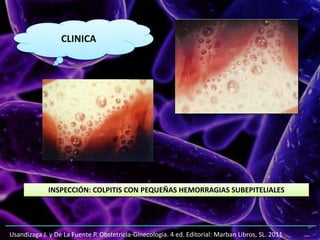 Usandizaga J. y De La Fuente P. Obstetricia-Ginecologia. 4 ed. Editorial: Marban Libros, SL. 2011
CLINICA
INSPECCIÓN: COLPITIS CON PEQUEÑAS HEMORRAGIAS SUBEPITELIALES
 