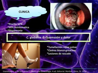 Usandizaga J. y De La Fuente P. Obstetricia-Ginecologia. 4 ed. Editorial: Marban Libros, SL. 2011
CLINICA
*Prurito 50%
*20% Asintomatica
*Dispareunia
C. glabatra  Quemazón y dolor
*Tumefacción rojiza vulvar
*Costras blanco-grisaceas
*Lesiones de rascado
 