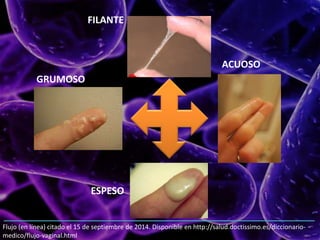 Flujo (en línea) citado el 15 de septiembre de 2014. Disponible en http://salud.doctissimo.es/diccionario-
medico/flujo-vaginal.html
FILANTE
GRUMOSO
ESPESO
ACUOSO
 