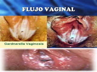 FLUJO VAGINALFLUJO VAGINAL
 