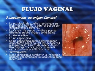 FLUJO VAGINALFLUJO VAGINAL
3.Leucorreas de origen Cervical3.Leucorreas de origen Cervical::
• La patología de cuello uterino que se
manifiesta por flujo genital puede ser
inflamatoria o tumoral.
• La Cervicitis puede dividirse por su
etiología en dos grupos principales:
• La Gonorréica
• La no especifica
• La no específica suelen desempeñar
importante papel causal los desgarros
puerperales, resulta de infección por
diversos gérmenes, principalmente
estreptococos y estafilococos.
• Tratamiento:
• Debe dirigirse a combatir la infección
general y a erradicar la local en la zona
infectada.
 