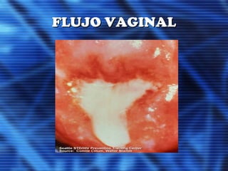 FLUJO VAGINALFLUJO VAGINAL
 