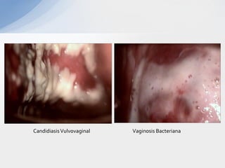 CandidiasisVulvovaginal Vaginosis Bacteriana
 