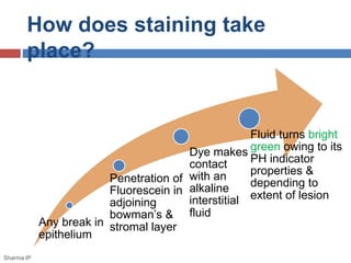 How does staining take
place?
Any break in
epithelium
Penetration of
Fluorescein in
adjoining
bowman’s &
stromal layer
Dye makes
contact
with an
alkaline
interstitial
fluid
Fluid turns bright
green owing to its
PH indicator
properties &
depending to
extent of lesion
Sharma IP
 