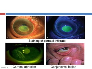 Staining of corneal infiltrate
Corneal abrasionSharma IP Conjunctival lesion
 