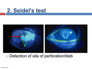 2. Seidel's test
 Detection of site of perforation/bleb
Sharma IP
 
