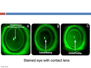 Stained eye with contact lens
Sharma IP
 