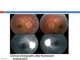 Clinical photographs after fluorescein
angiographySharma IP
 