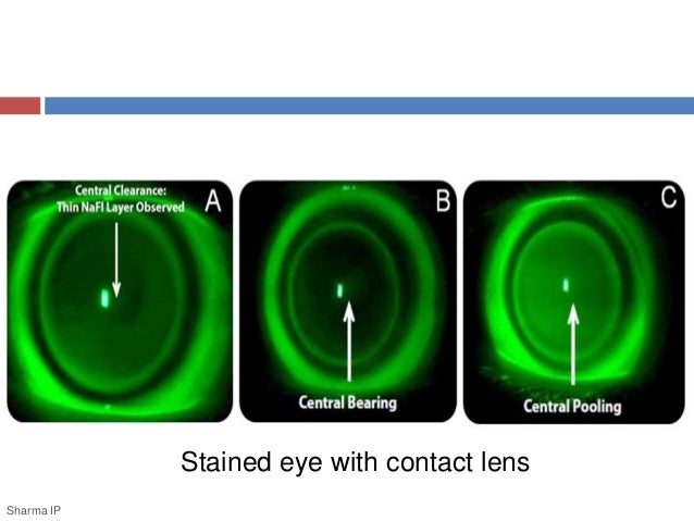 Contact Lens Fitting Fluorescein