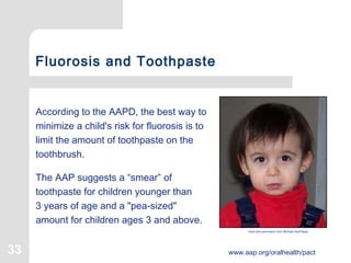 33 www.aap.org/oralhealth/pact
Fluorosis and Toothpaste
According to the AAPD, the best way to
minimize a child's risk for fluorosis is to
limit the amount of toothpaste on the
toothbrush.
The AAP suggests a “smear” of
toothpaste for children younger than
3 years of age and a "pea-sized"
amount for children ages 3 and above.
Used with permission from Michael SanFilippo
 