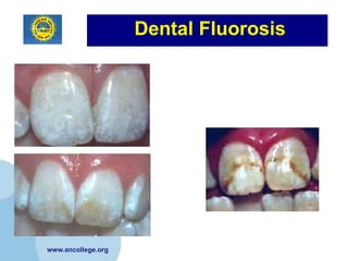Dental Fluorosis




www.ancollege.org
 