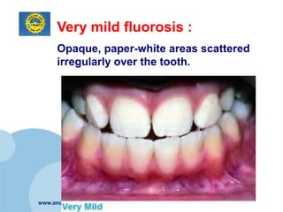 Very mild fluorosis :
      Opaque, paper-white areas scattered
      irregularly over the tooth.




www.ancollege.org
 