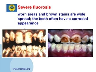 Severe fluorosis
    worn areas and brown stains are wide
    spread; the teeth often have a corroded
    appearance.




www.ancollege.org
 