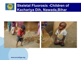 Skeletal Fluorosis -Children of
       Kachariya Dih, Nawada,Bihar




www.ancollege.org
 