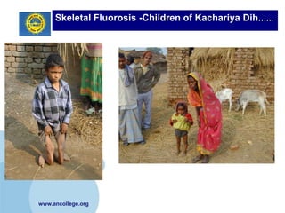 Skeletal Fluorosis -Children of Kachariya Dih......




www.ancollege.org
 